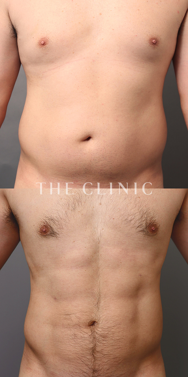 胸部のデザイン・SIX PACK ６つに割れた腹筋のベイザー4D(男性のシックスパック脂肪吸引)（31歳男性）の術前・術後写真
