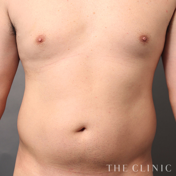 胸部のデザイン・SIX PACK ６つに割れた腹筋のベイザー4D(男性のシックスパック脂肪吸引)（31歳男性）の術前写真