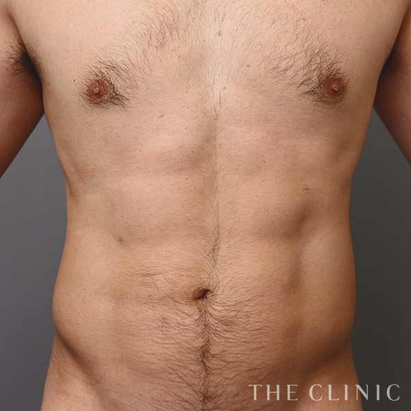 胸部のデザイン・SIX PACK ６つに割れた腹筋のベイザー4D(男性のシックスパック脂肪吸引)（31歳男性）の術後写真