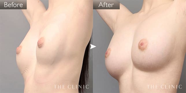 ボリュームアップ(女性/35歳)