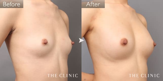 豊胸・胸の整形 ボリュームアップ 症例写真