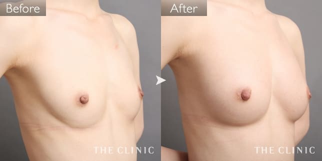 ボリュームアップ(女性/27歳)