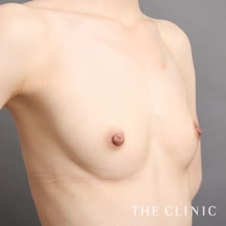 【THE CLINIC 症例画像】No.957_1_ボリュームアップ_コンデンスリッチ豊胸(執刀医:志田 雅明)