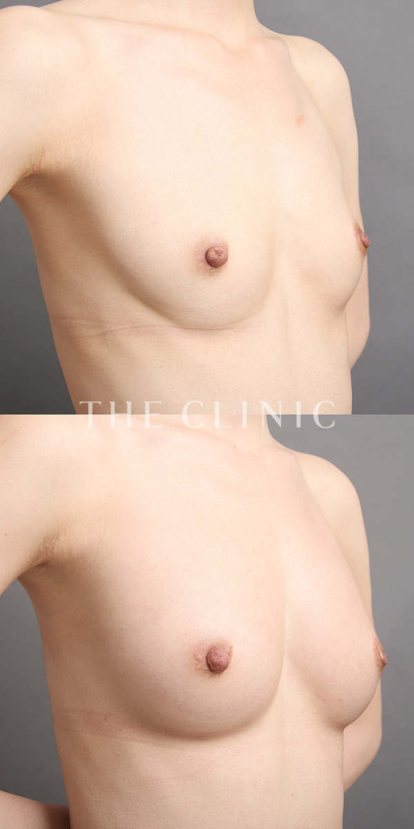 ボリュームアップのコンデンスリッチ豊胸（27歳女性）の術前・術後写真