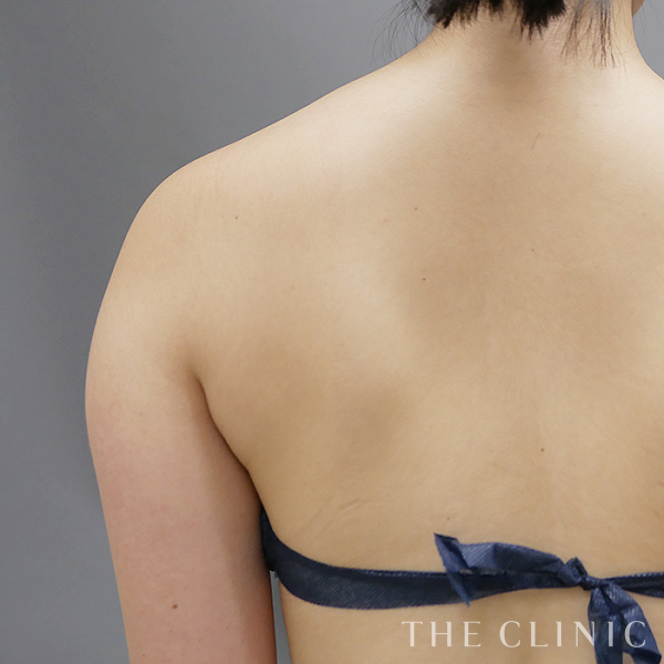 二の腕・腕の付け根のベイザー脂肪吸引（21歳女性）の術前写真