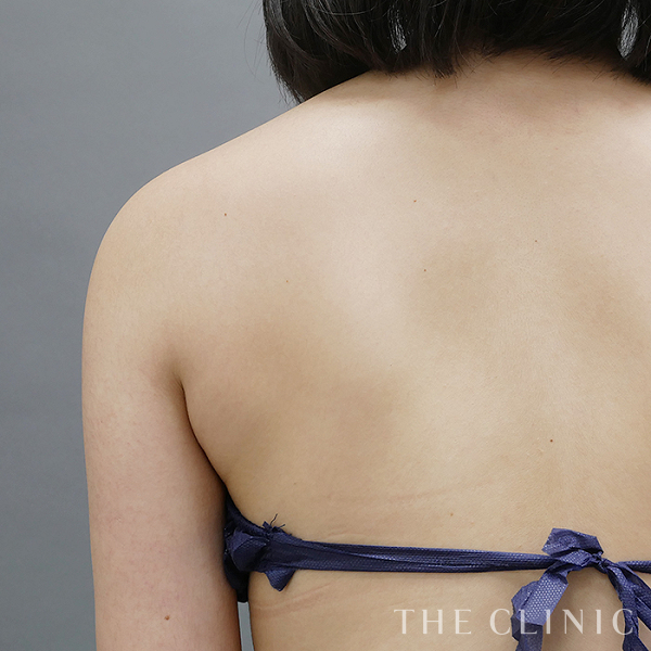 二の腕・腕の付け根のベイザー脂肪吸引（21歳女性）の術後写真