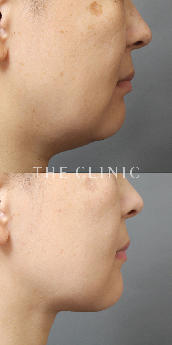 頰／顎のベイザー脂肪吸引（47歳女性）の術前・術後写真