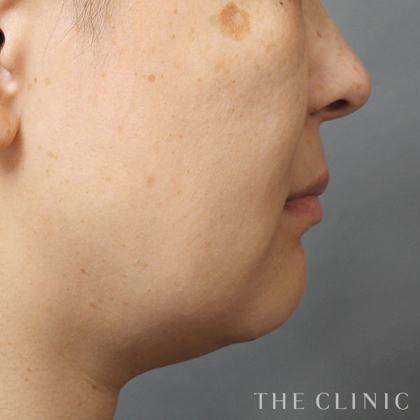 頰／顎のベイザー脂肪吸引（47歳女性）の術前写真