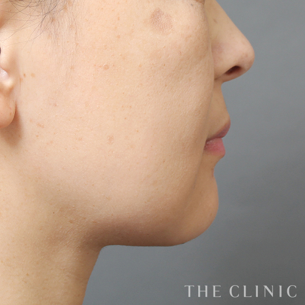 頰／顎のベイザー脂肪吸引（47歳女性）の術後写真