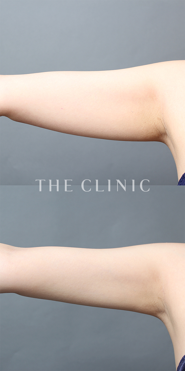 二の腕のベイザー脂肪吸引（30歳女性）の術前・術後写真