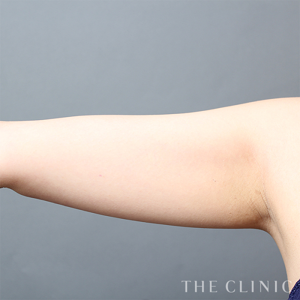 二の腕のベイザー脂肪吸引（30歳女性）の術前写真
