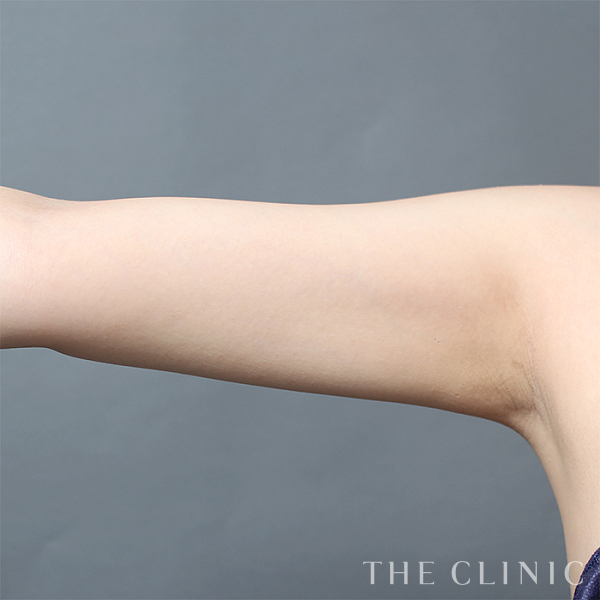 二の腕のベイザー脂肪吸引（30歳女性）の術後写真