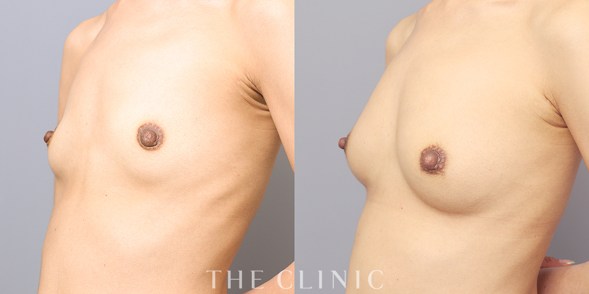 コンデンスリッチ豊胸の術前／術後