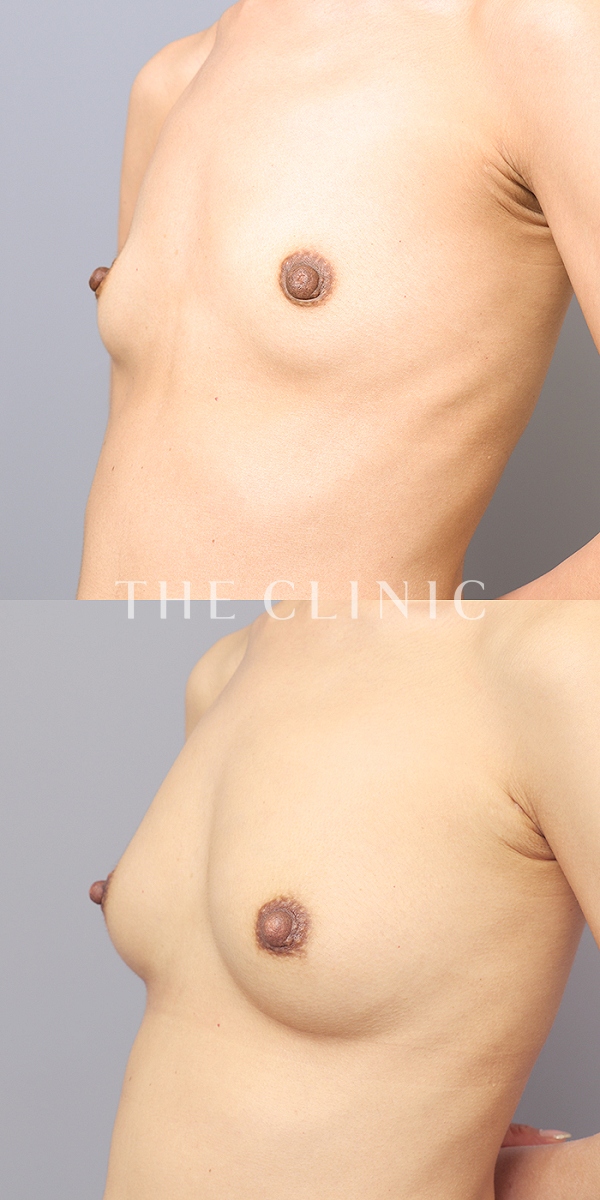 ボリュームアップのコンデンスリッチ豊胸（39歳女性）の術前・術後写真