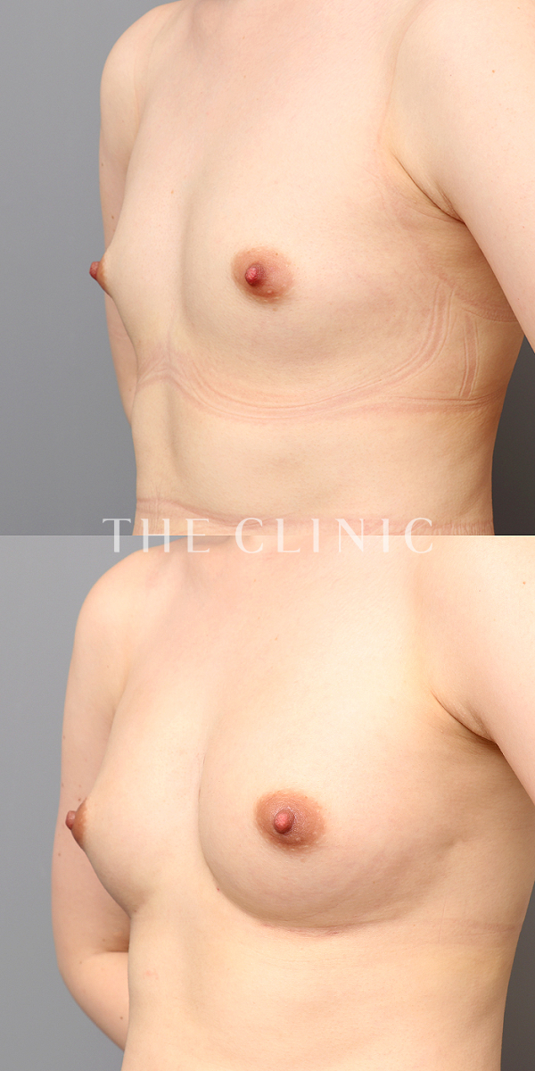 ボリュームアップの上向きバスト豊胸（27歳女性）の術前・術後写真