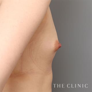 【THE CLINIC 症例画像】No.965_1_ボリュームアップ_上向きバスト豊胸(執刀医:村田 八千穂)