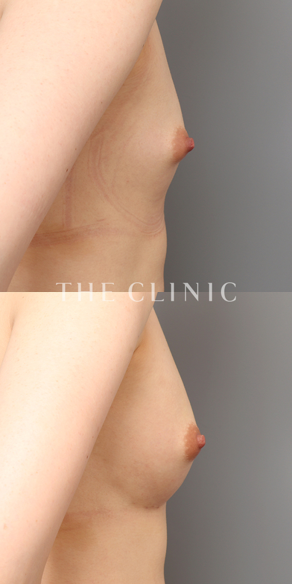 ボリュームアップの上向きバスト豊胸（27歳女性）の術前・術後写真