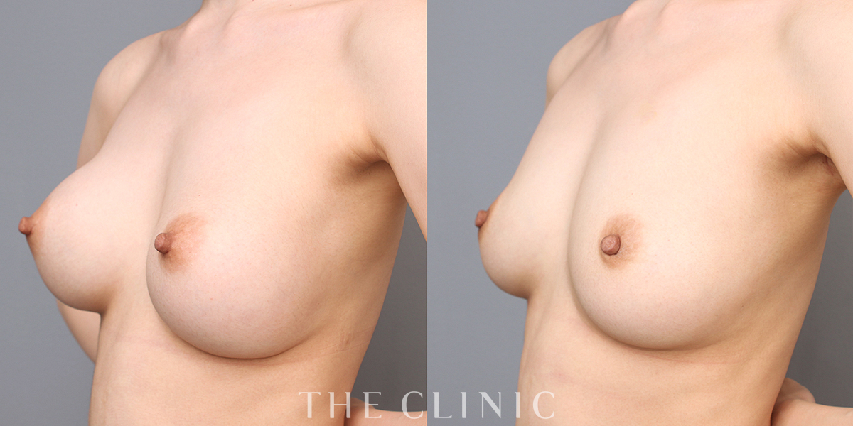 豊胸シリコンバッグ除去の術前/術後