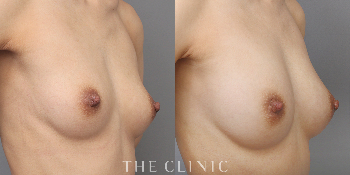 コンデンスリッチ豊胸の術前/術後