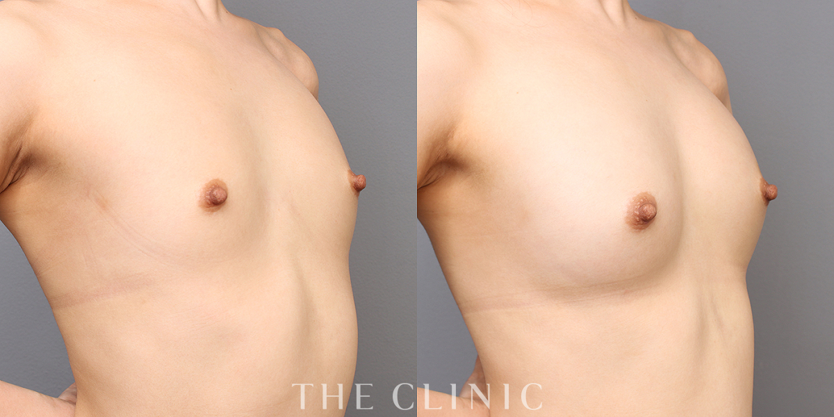 コンデンスビブラ豊胸の術前/術後