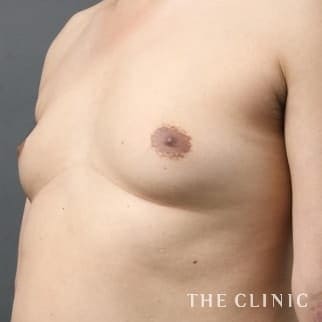 【THE CLINIC 症例画像】No.96_1_女性化乳房_女性化乳房治療(男性の胸の膨らみ改善)