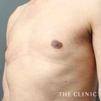 【THE CLINIC 症例画像】No.96_2_女性化乳房_女性化乳房治療(男性の胸の膨らみ改善)