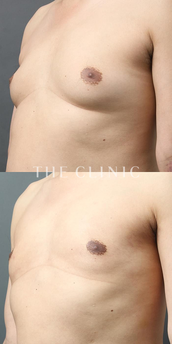 女性化乳房・偽性女性化乳房の女性化乳房治療(男性の胸の膨らみ改善)（41歳男性）の術前・術後写真