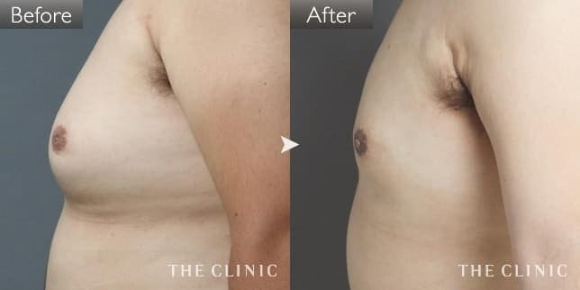 女性化乳房（男性／26歳）