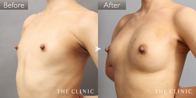 豊胸・胸の整形 ボリュームアップ 症例写真