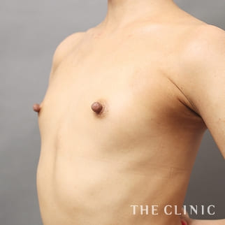 【THE CLINIC 症例画像】No.971_1_ボリュームアップ_BRAVA×コンデンスリッチ豊胸(執刀医:大橋 昌敬)
