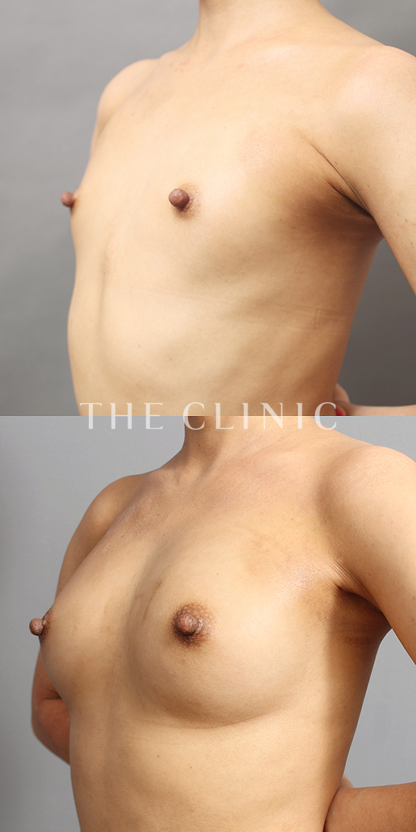 ボリュームアップのBRAVA×コンデンスリッチ豊胸（34歳女性）の術前・術後写真