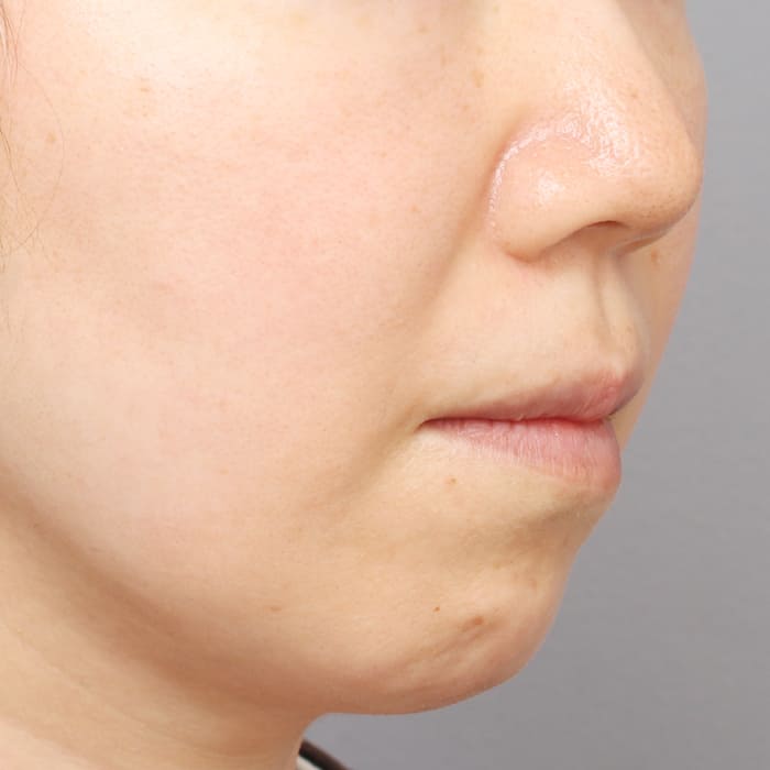 【THE CLINIC 症例画像】No.979_2_頰/顎_360脂肪吸引®(執刀医:村田 八千穂)