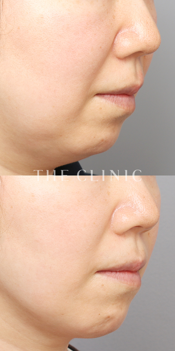 頰／顎のベイザー脂肪吸引（45歳女性）の術前・術後写真