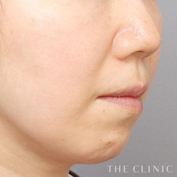 頰／顎のベイザー脂肪吸引（45歳女性）の術後写真