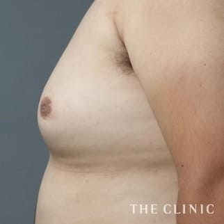 【THE CLINIC 症例画像】No.97_1_女性化乳房_女性化乳房治療(男性の胸の膨らみ改善)