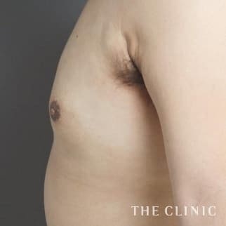 【THE CLINIC 症例画像】No.97_2_女性化乳房_女性化乳房治療(男性の胸の膨らみ改善)
