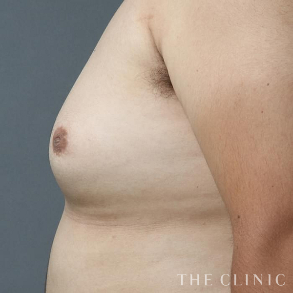女性化乳房・偽性女性化乳房の女性化乳房治療(男性の胸の膨らみ改善)（26歳男性）の術前写真