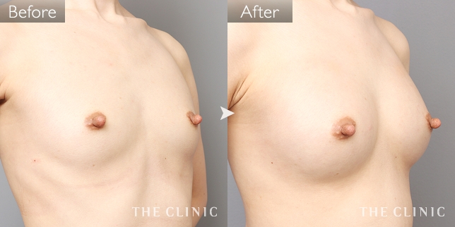 ボリュームアップ（女性／26歳）