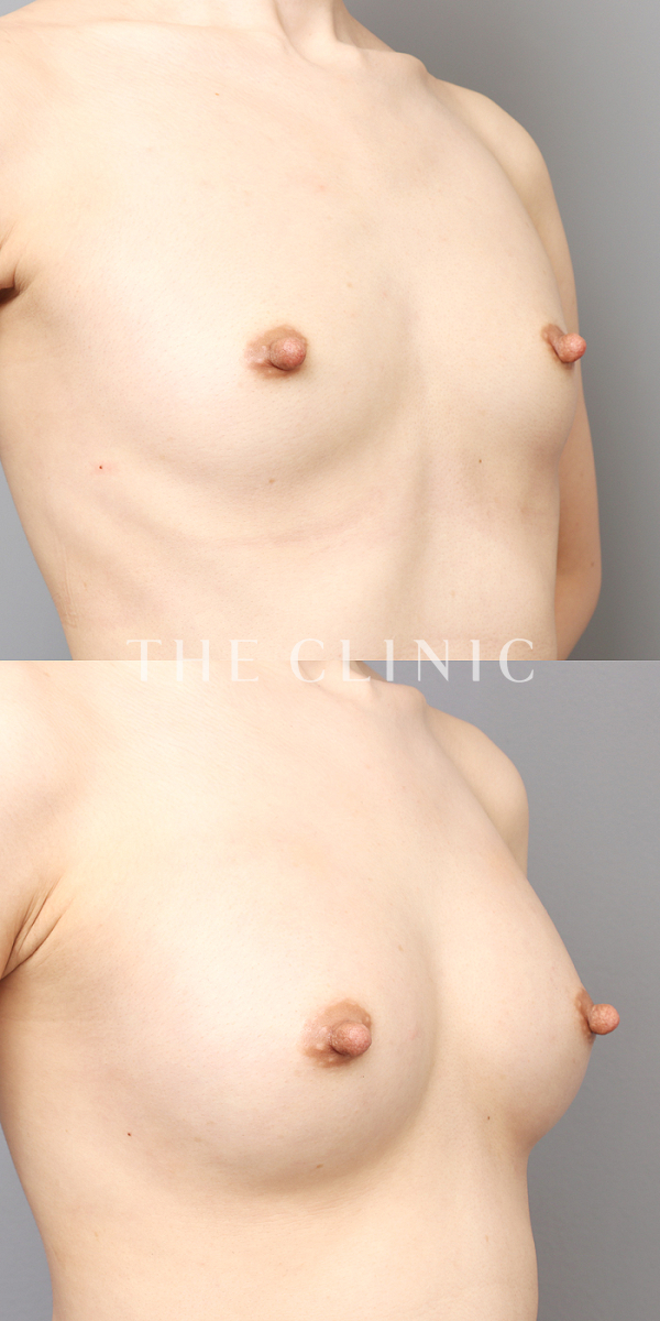 ボリュームアップのコンデンスビブラ豊胸（26歳女性）の術前・術後写真