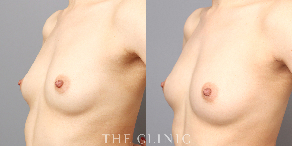 コンデンスリッチ豊胸の術前/術後