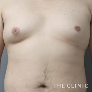 女性化乳房／偽性女性化乳房の女性化乳房治療(男性の胸の膨らみ改善)のモニター（20代）術前症例画像