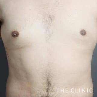 女性化乳房／偽性女性化乳房の女性化乳房治療(男性の胸の膨らみ改善)のモニター（20代）術後症例画像