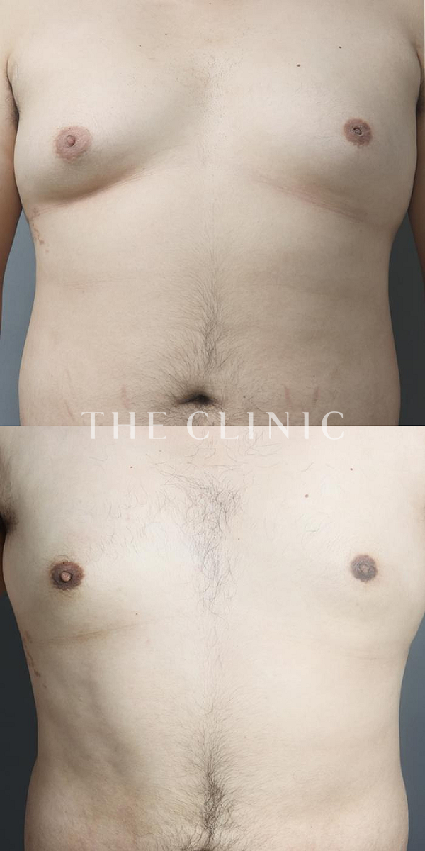 女性化乳房・偽性女性化乳房の女性化乳房治療(男性の胸の膨らみ改善)（26歳男性）の術前・術後写真