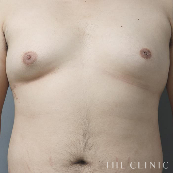 女性化乳房・偽性女性化乳房の女性化乳房治療(男性の胸の膨らみ改善)（26歳男性）の術前写真