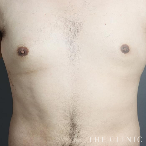 女性化乳房・偽性女性化乳房の女性化乳房治療(男性の胸の膨らみ改善)（26歳男性）の術後写真