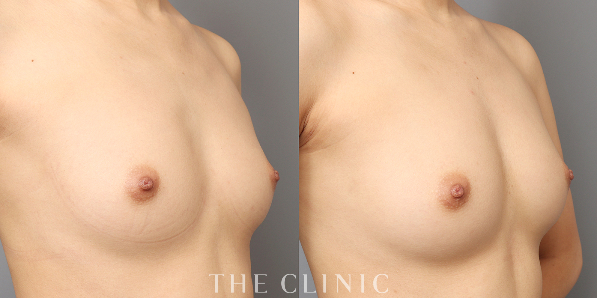 コンデンスリッチ豊胸の術前/術後