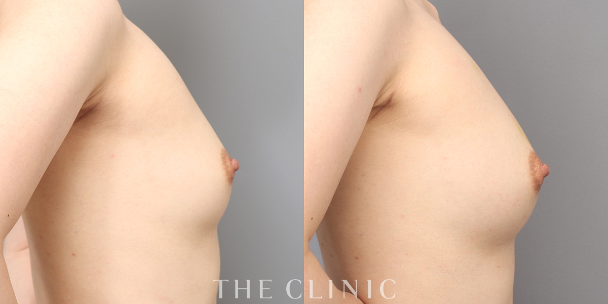 コンデンスリッチ豊胸の術前/術後