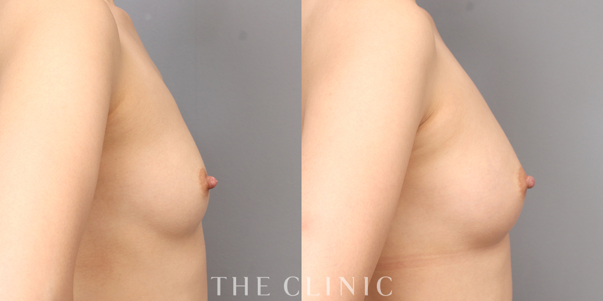 コンデンスリッチ豊胸の術前／術後