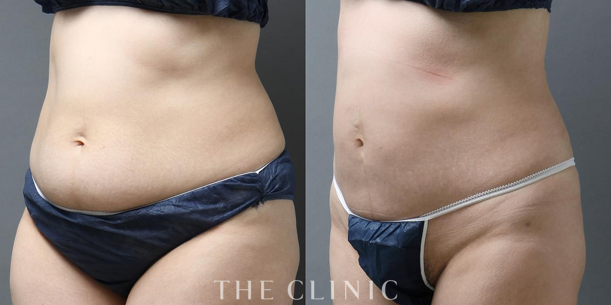 360脂肪吸引®の術前／術後