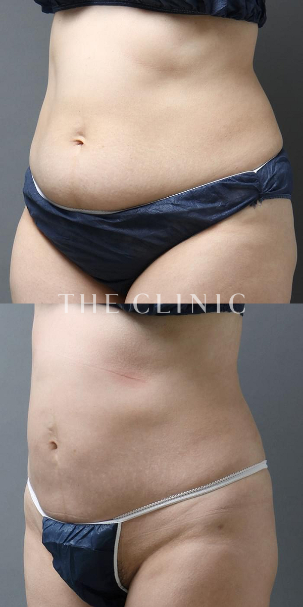 腹部の360脂肪吸引®（44歳女性）の術前・術後写真